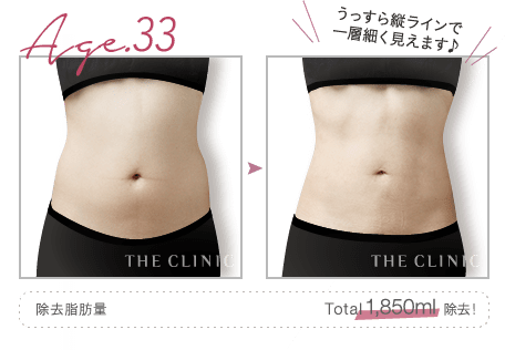 Age.33 うっすら縦ラインで一層細く見えます♪ | 除去脂肪量: Total 1,850ml 除去！