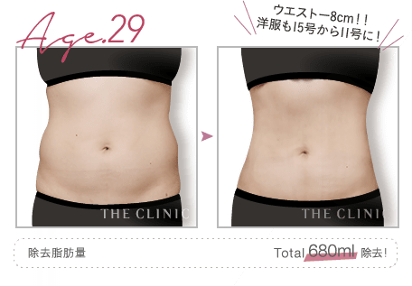 Age.29 ウエストー8cm！！ 洋服も15号から11号に！ | 除去脂肪量: Total 680ml 除去！