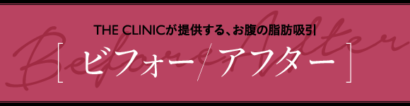 THE CLINICが提供する、お腹の脂肪吸引 [ ビフォー/アフター ]