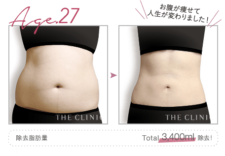 Age.27 お腹が痩せて人生が変わりました! | 除去脂肪量: Total 3,400ml 除去!