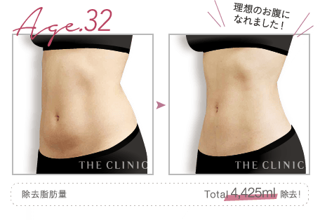 Age.32 理想のお腹になれました! | 除去脂肪量: Total 4,425ml 除去!