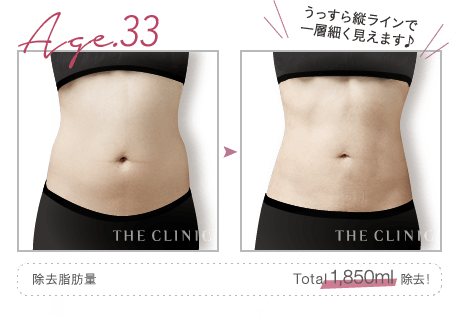 Age.33 うっすら縦ラインで一層細く見えます♪ | 除去脂肪量: Total 1,850ml 除去!