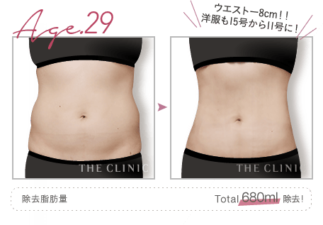 Age.29 ウエストー8cm!! 洋服も15号から11号に! | 除去脂肪量: Total 680ml 除去!