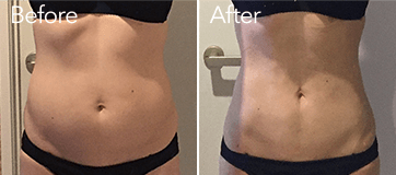 お腹の脂肪吸引前と術後31日目の比較写真