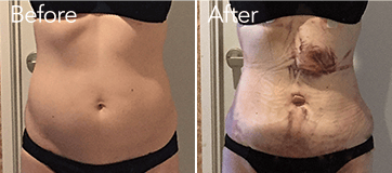 お腹の脂肪吸引前と術後1日目の比較写真