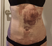 お腹の脂肪吸引の術後2日目のむくみ・内出血