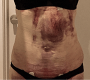 お腹の脂肪吸引の術後3日目のむくみ・内出血