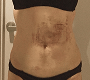 お腹の脂肪吸引の術後10日目のむくみ・内出血