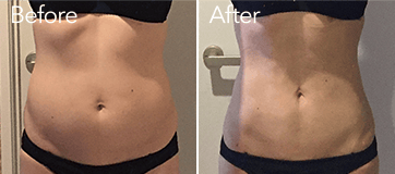 お腹の脂肪吸引前と術後31日目の比較写真