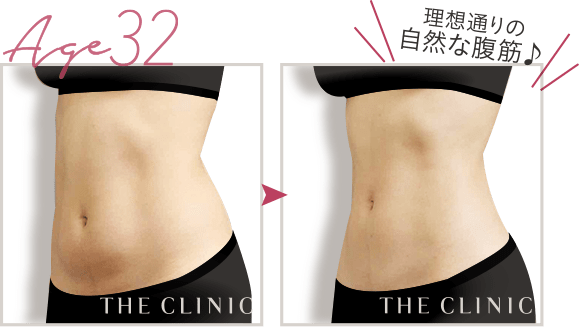 お腹（上腹／下腹／腰）の脂肪吸引モニター