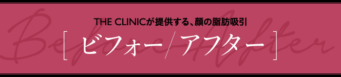 THE CLINICが提供する、顔の脂肪吸引 [ ビフォー/アフター ]