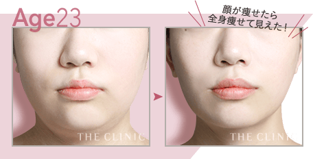 【23歳女性】顔(頬＋顎下)の脂肪吸引・二重顎が解消し小顔に