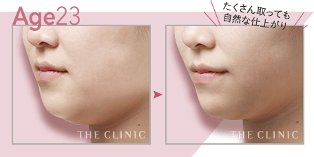 【23歳女性】顔(頬＋顎下)の脂肪吸引・たくさん取っても自然な仕上がり