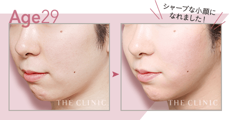 【29歳女性】顔(頬＋顎下)の脂肪吸引・シャープな小顔に