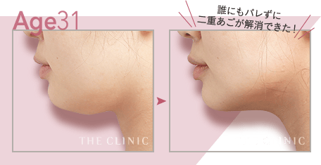 【31歳女性】顔(頬＋顎下)の脂肪吸引・だれにもバレずに二重顎が解消