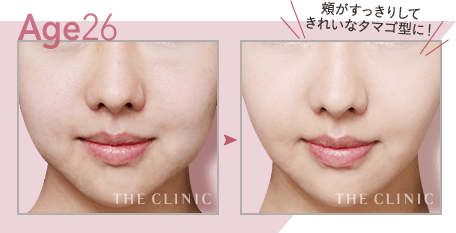 【26歳女性】顔(頬＋顎下)の脂肪吸引・頬がスッキリ キレイな卵型の小顔に