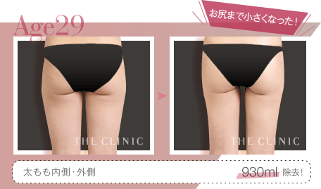 Age29 お尻まで小さくなった! | 太もも内側・外側 930ml除去!