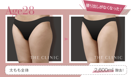 Age28 張り出しがなくなった! | 太もも全体 2,600ml除去!
