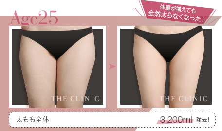 Age25 体重が増えても 全然太らなくなった！ | 太もも全体 3,200ml除去！