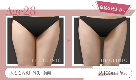 Age28 自然な仕上がり | 太もも内側・外側・前面 2,100ml除去！