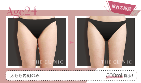 Age24 憧れの隙間 | 太もも内側のみ 500ml除去！