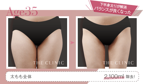 Age35 下半身太りが解消 バランスが良くなった | 太もも全体 2,100ml除去！