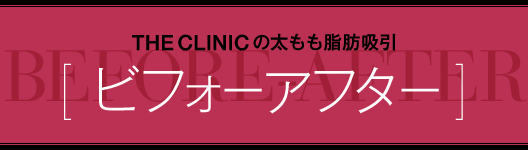  THE CLINIC の太もも脂肪吸引 [ ビフォーアフター ]