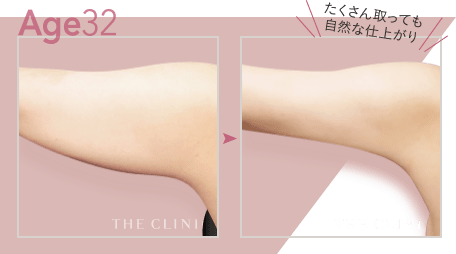 Age32 たくさん取っても自然な仕上がり