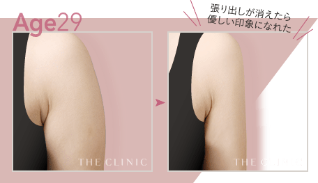 Age29 張り出しが消えたら優しい印象になれた