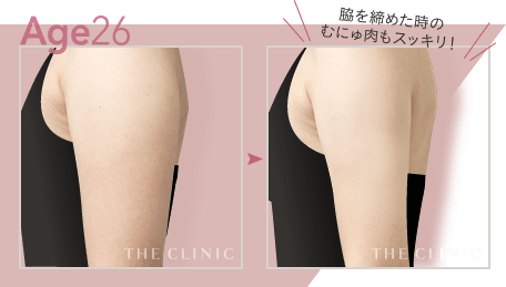 Age26 脇を締めた時のむにゅ肉もスッキリ！