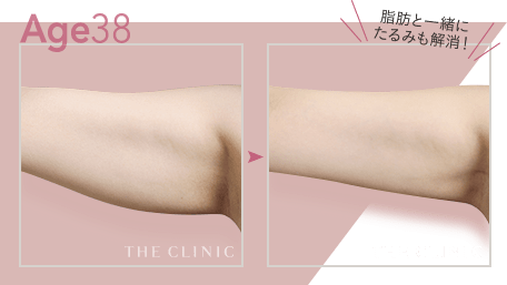 Age38 脂肪と一緒にたるみも解消!