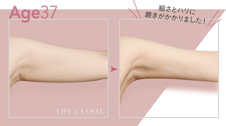 Age37 細さとハリに磨きがかかりました!