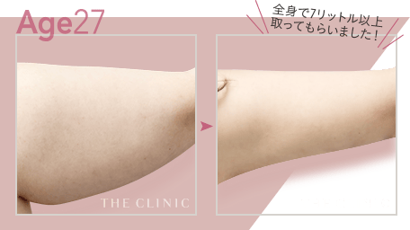 Age27 全身で7リットル以上取ってもらいました！