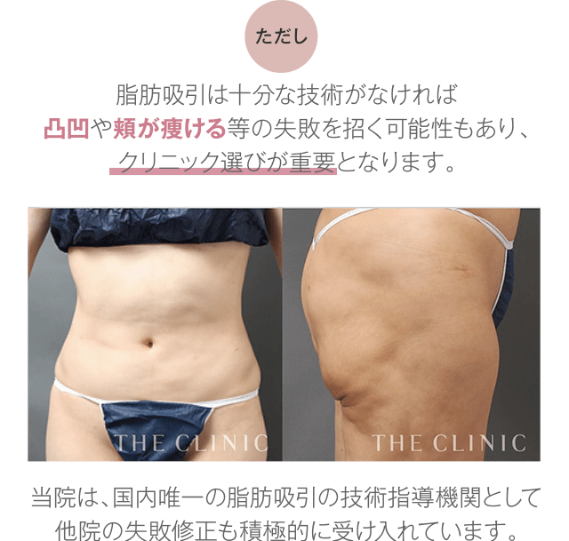 二の腕の脂肪吸引で夏袖美人｜今だけ二の腕モニターも募集中！