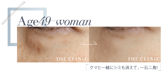 Age49 クマと一緒にシミも消えて、一石二鳥！