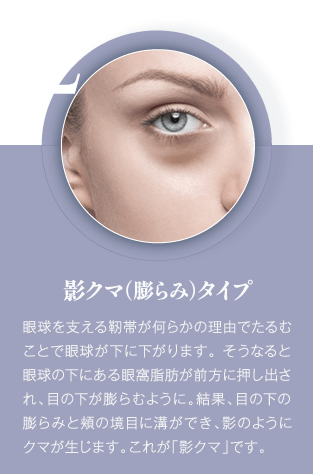 影クマ（膨らみ）| 眼球を支える靭帯が何らかの理由でたるむことで眼球が下に下がります。 そうなると眼球の下にある眼窩脂肪が前方に押し出され、目の下が膨らむように。結果、目の下の膨らみと頬の境目に溝ができ、影のようにクマが生じます。これが「影クマ」です。