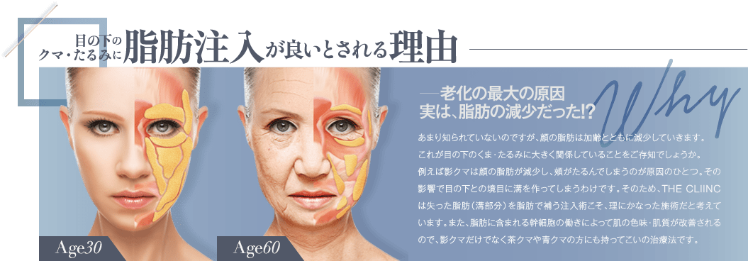 目の下のクマ・たるみに脂肪注入が良いとされる理由 | 老化の最大の原因 実は、脂肪の減少だった!? | あまり知られていないのですが、顔の脂肪は加齢とともに減少していきます。これが目の下のくま・たるみに大きく関係していることをご存知でしょうか。例えば影クマは顔の脂肪が減少し、頬がたるんでしまうのが原因のひとつ。その影響で目の下との境目に溝を作ってしまうわけです。そのため、THE CLIINC は失った脂肪（溝部分）を脂肪で補う注入術こそ、理にかなった施術だと考えています。また、脂肪に含まれる幹細胞の働きによって肌の色味・肌質が改善されるので、影クマだけでなく茶クマや青クマの方にも持ってこいの治療法です。