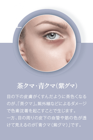茶クマ 青クマ(紫クマ)| 目の下の皮膚がくすんだように茶色くなるのが、「茶クマ」。紫外線などによるダメージで色素沈着を起こすことで生じます。一方、目の周りの皮下の血管や筋の色が透けて見えるのが「青クマ(紫グマ)」です。
