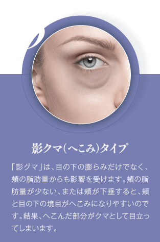 影クマ(へこみ)| 「影グマ」は、目の下の膨らみだけでなく、頬の脂肪量からも影響を受けます。頬の脂肪量が少ない、または頬が下垂すると、頬と目の下の境目がへこみになりやすいのです。結果、へこんだ部分がクマとして目立ってしまいます。