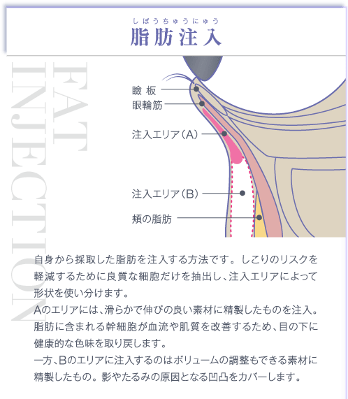 脂肪注入 | 自身から採取した脂肪を注入する方法です。 しこりのリスクを軽減するために良質な細胞だけを抽出し、注入エリアによって形状を使い分けます。Aのエリアには、滑らかで伸びの良い素材に精製したものを注入。脂肪に含まれる幹細胞が血流や肌質を改善するため、目の下に健康的な色味を取り戻します。一方、Bのエリアに注入するのはボリュームの調整もできる素材に精製したもの。 影やたるみの原因となる凹凸をカバーします。