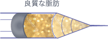 治療法「経結膜脱脂」はこちら