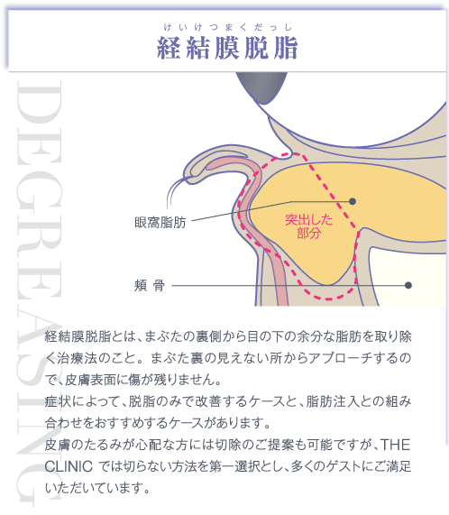 経結膜脱脂 | 経結膜脱脂とは、まぶたの裏側から目の下の余分な脂肪を取り除く治療法のこと。 まぶた裏の見えない所からアプローチするので、皮膚表面に傷が残りません。症状によって、脱脂のみで改善するケースと、脂肪注入との組み合わせをおすすめするケースがあります。皮膚のたるみが心配な方には切除のご提案も可能ですが、THE CLINIC では切らない方法を第一選択とし、多くのゲストにご満足いただいています。