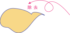 治療法「経結膜脱脂」はこちら