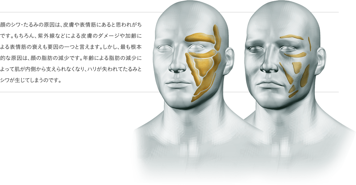 顔のシワ・たるみの原因は、皮膚や表情筋にあると思われがちです。もちろん、紫外線などによる皮膚のダメージや加齢による表情筋の衰えも要因の一つと言えます。しかし、最も根本的な原因は、顔の脂肪の減少です。年齢による脂肪の減少によって肌が内側から支えられなくなり、ハリが失われてたるみとシワが生じてしまうのです。