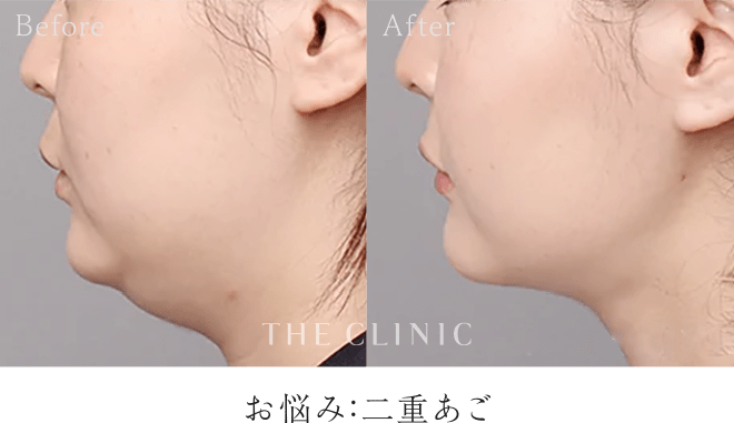 タイトニング脂肪吸引の症例｜お悩み：二重あご