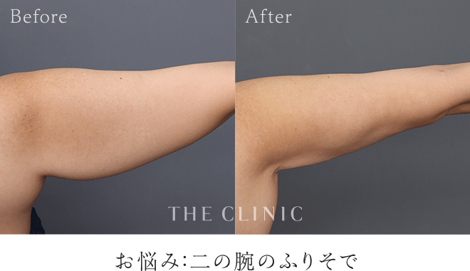 タイトニング脂肪吸引の症例｜お悩み：二の腕のふりそで