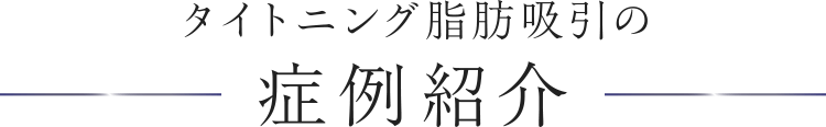 タイトニング脂肪吸引の症例紹介