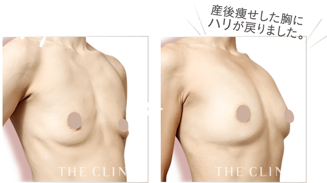 産後の痩せた胸にハリが戻った症例