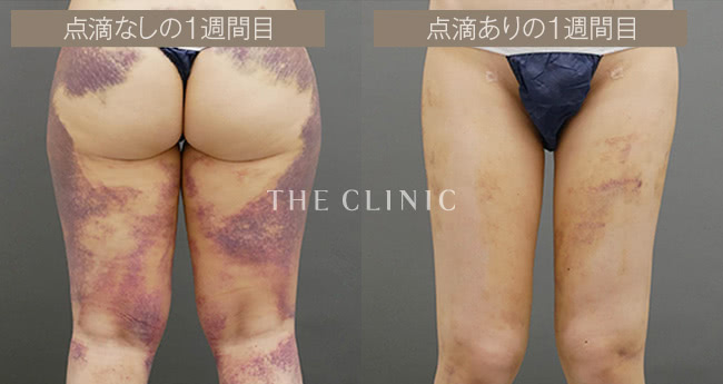 点滴無しの１週間目 / 点滴ありの１週間目