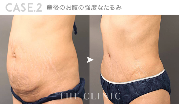 CASE.2 産後のお腹の強度なたるみ